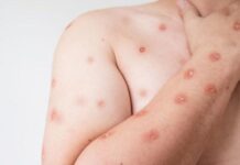 Saúde alerta para monitoramento da Mpox em MT após avanço de variante em RO